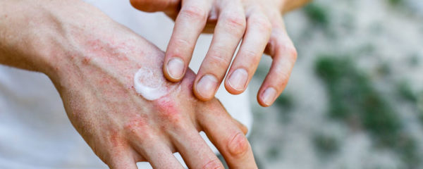 Crème spécial psoriasis