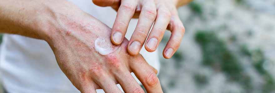 Crème spécial psoriasis